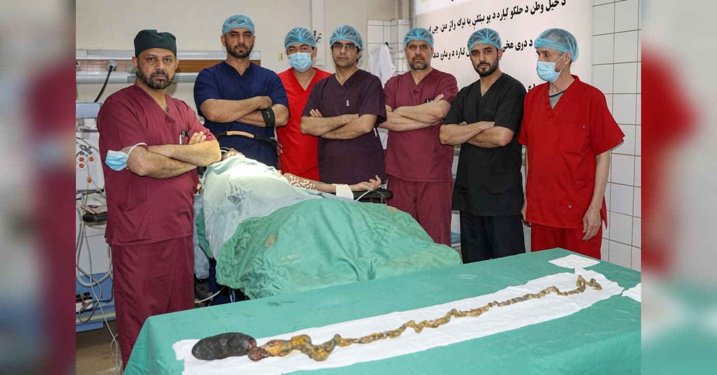 جراحى موفق خارج سازى كتله موى بزرگ از معده و روده يک زن در كابل.