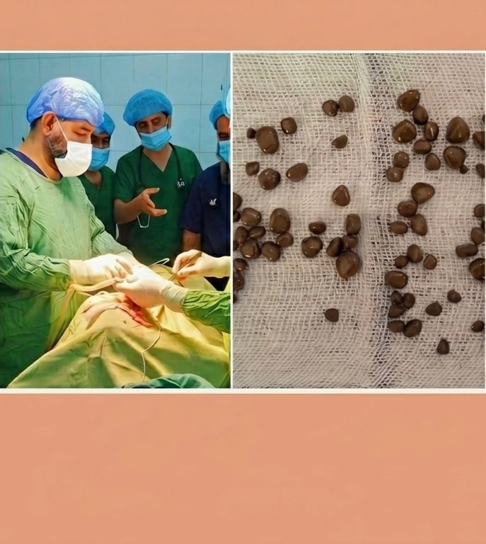 در شفاخانه همودیالیز ننگرهار، از کلیه یک بیمار ۲۰ ساله ۸۵ سنگ خارج شده است.